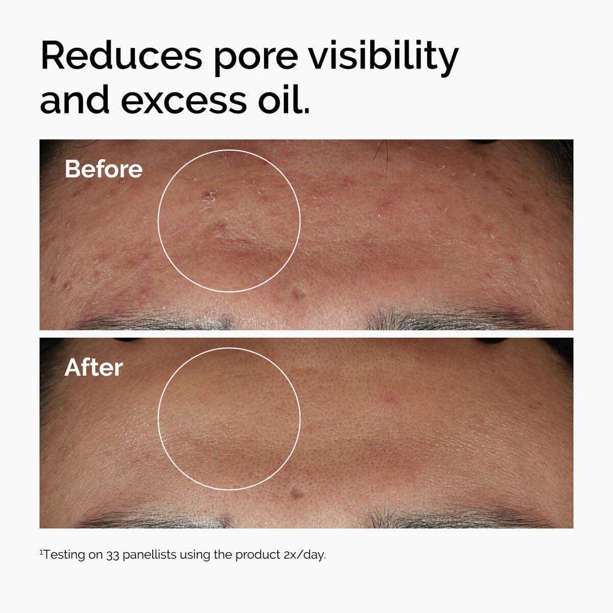 niacinamide-10-zinc-1-p0 ord-niacinamide-zinc-blemish-serum-before-after-pores.jpg