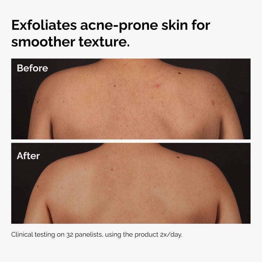 the-body-care-collection-v6 ord-salicylic-acid-body-serum-before-after-graphic-NA.jpg